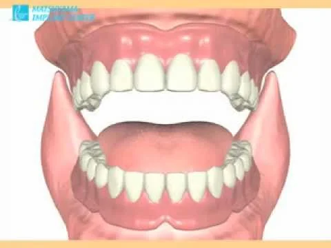 ワンデイインプラント®の動画